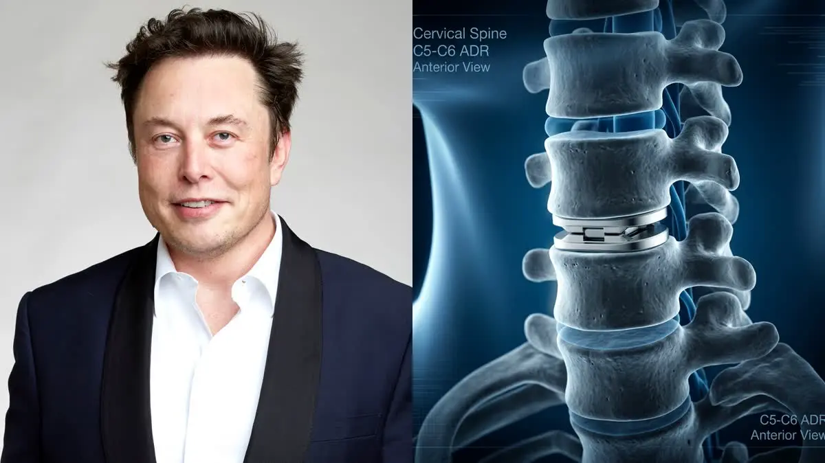Elon Musk Reveals "Insane" Back and Neck Pain After Sumo Stunt—A Deep Clinical Breakdown of Cervical Artificial Disc Replacement (ADR) vs. Fusion