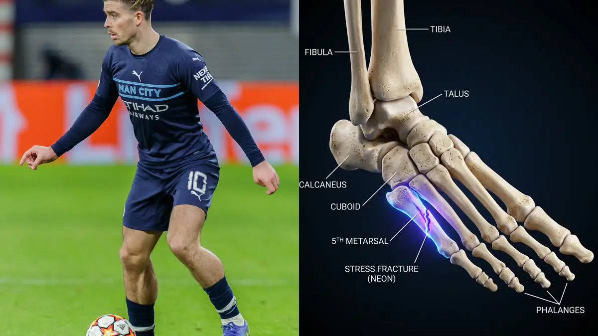 Jack Grealish's stress fracture of the foot: Soccer Biomechanics, Fifth Metatarsal Load, and Surgical Rehab