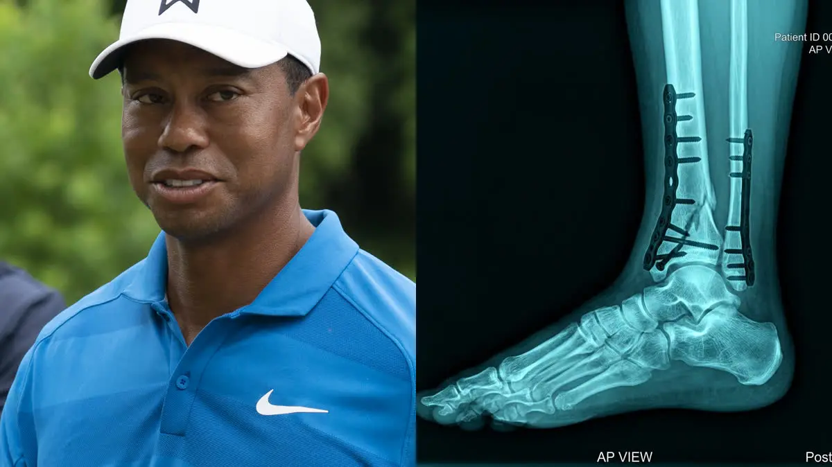 Tiger Woods' Long Road Back After Horrific 2021 Car Crash Leg Fractures: A Biomechanical Analysis of Subtalar Joint Fusion and Foot Drop Rehab
