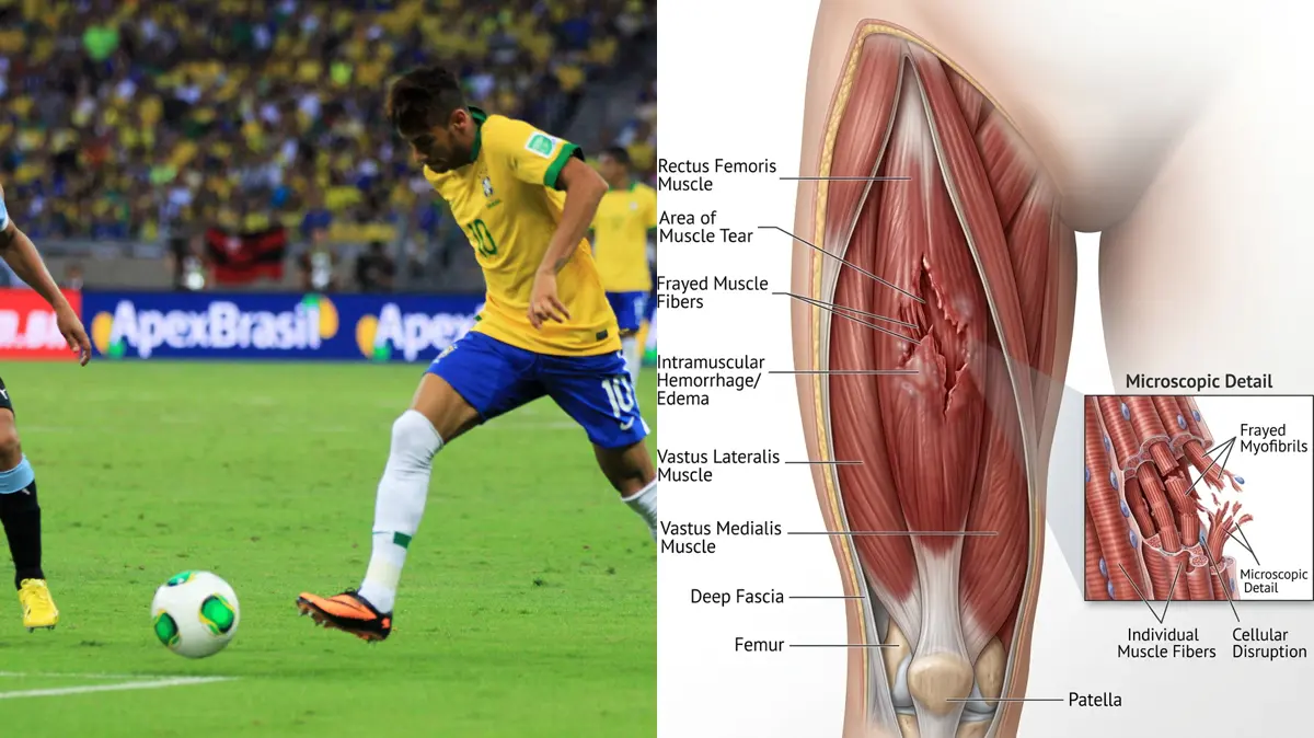 Brazil's World Cup Blow: The Biomechanics of Wesley's Thigh Muscle Fiber Tear and Elite Thigh Strain Recovery