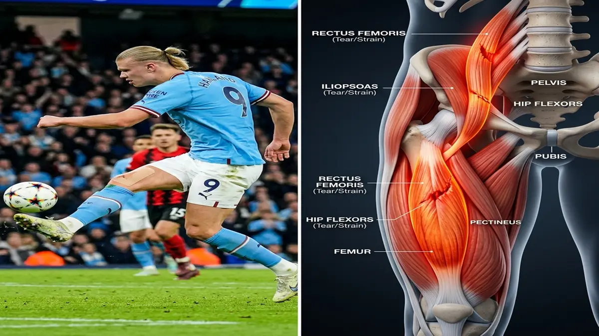 Erling Haaland's Hip Flexor Strain: Biomechanics of Explosive Acceleration, Recurrent Muscle Micro-tears, and Pelvic Stabilization